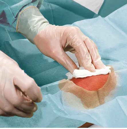 Foliodrape Protect Lochtuch 75x90cm 2-lagig Loch ø 10cm ohne Klebstreifen grün steril P.à 40